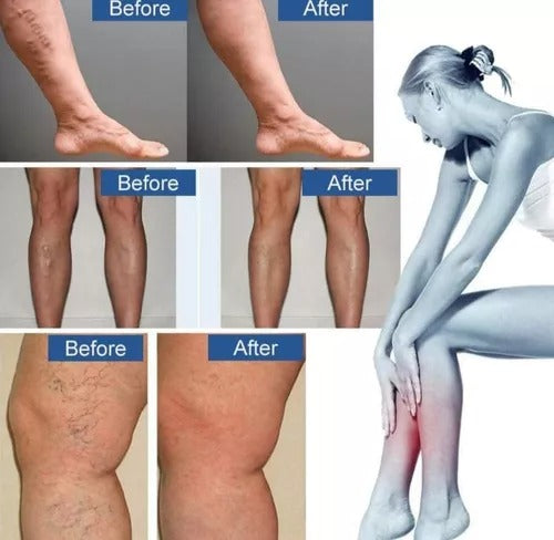 VenoPatch Max™:🦵¡Piernas libres de dolor, hinchazón y varices!🌿✨