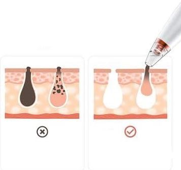 LimpiaPoros Spa™:💨✨ ¡Elimina puntos negros en minutos sin dolor ni esfuerzo!